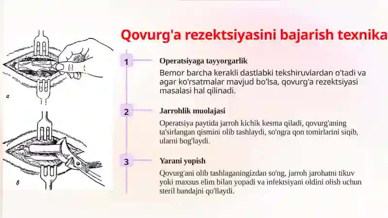 Qovurg'alar rezektsiya qilish texnikasi 4