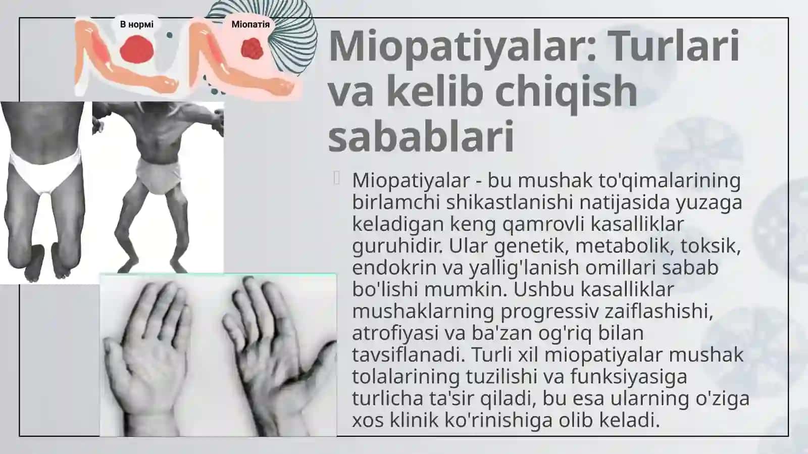 Miopatiyalar.Mushaklar denervatsiyasi. Miokard infarktining erta va kech biokimyoviy tashxisi 4