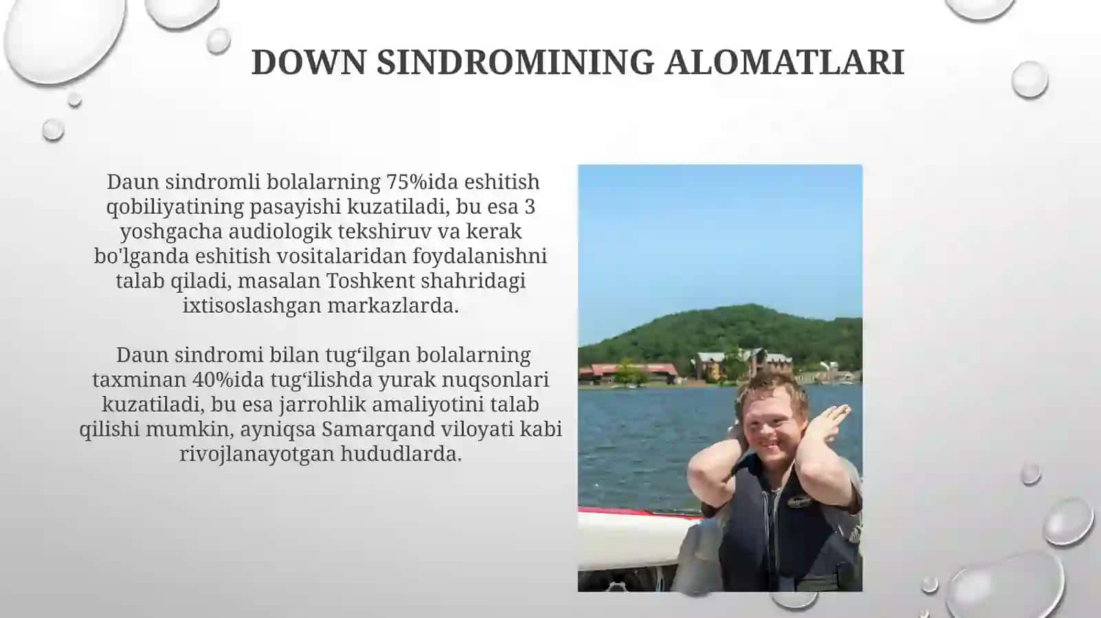 Daunsindromihaqida 4