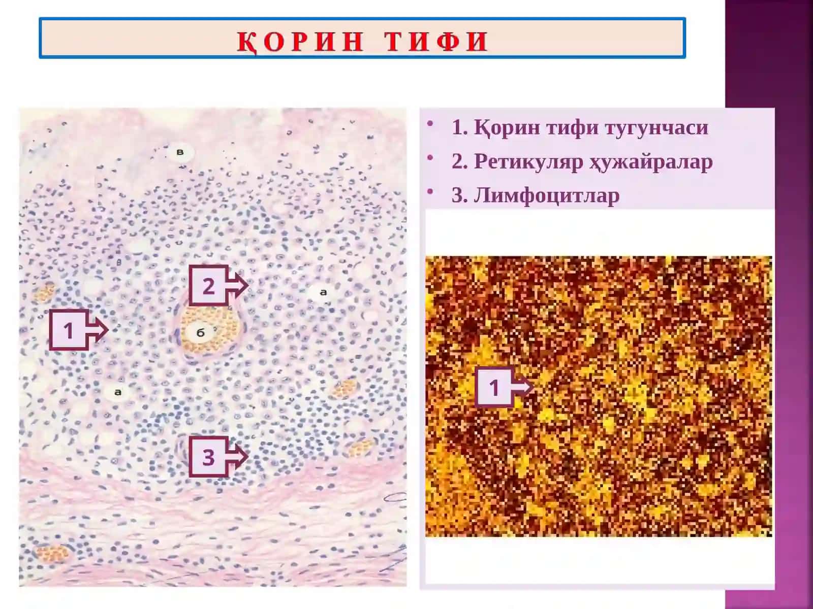 ПАТОЛОГИК АНАТОМИЯ “Ичак инфекциялари” 4