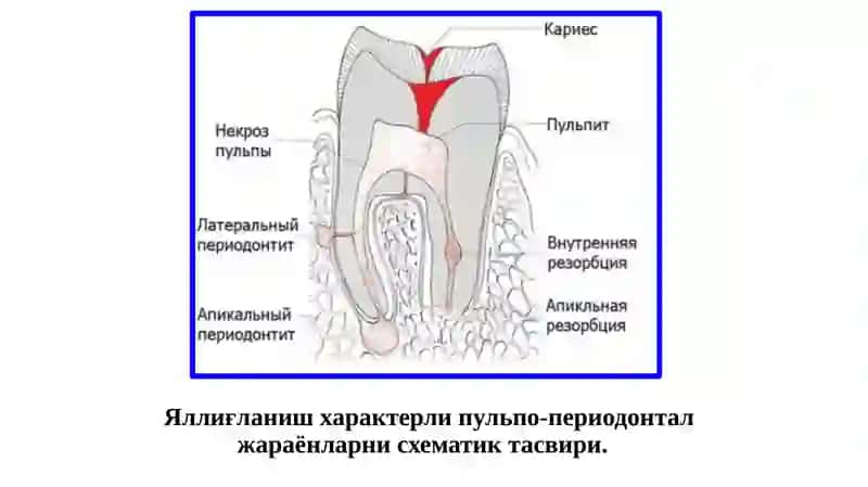 Ўткирва сурункали периодонтитларниклиникаси 4