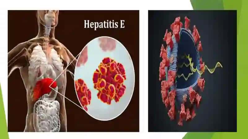 Virusli gepatit E etiologiyasi, patogenezi va davolash 4