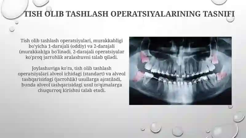 Tish olish operatsiyalari 4