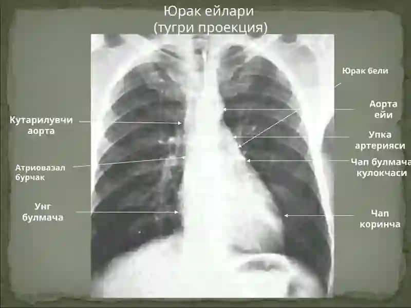 YURAK-QON TOMIRLARI KASALLIKLARI TASHXISIDA RENTGENOLOGIK USULLARNNING AXAMIYATI 4