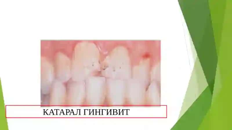 Gingivitlar.Kataral gingivit.Klinikasi,qiyosiy tashxis,davolash,profilaktika 4