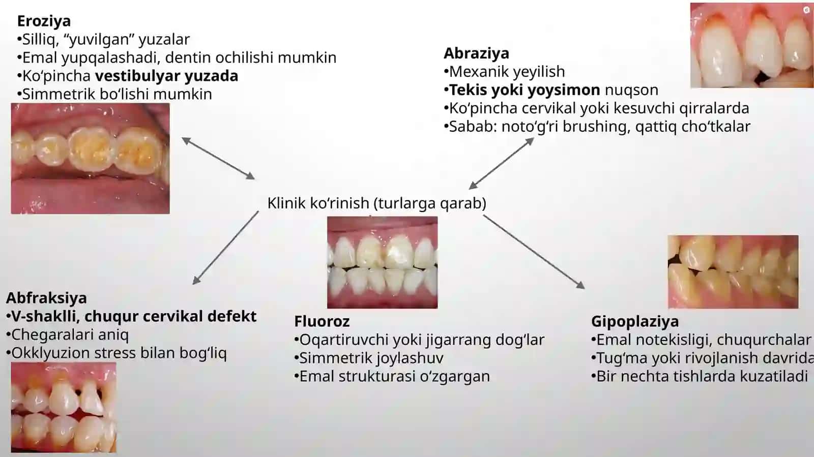 tish qattiq toʻqimalarini nokaries kasalliklarini restavrativ davolash 4