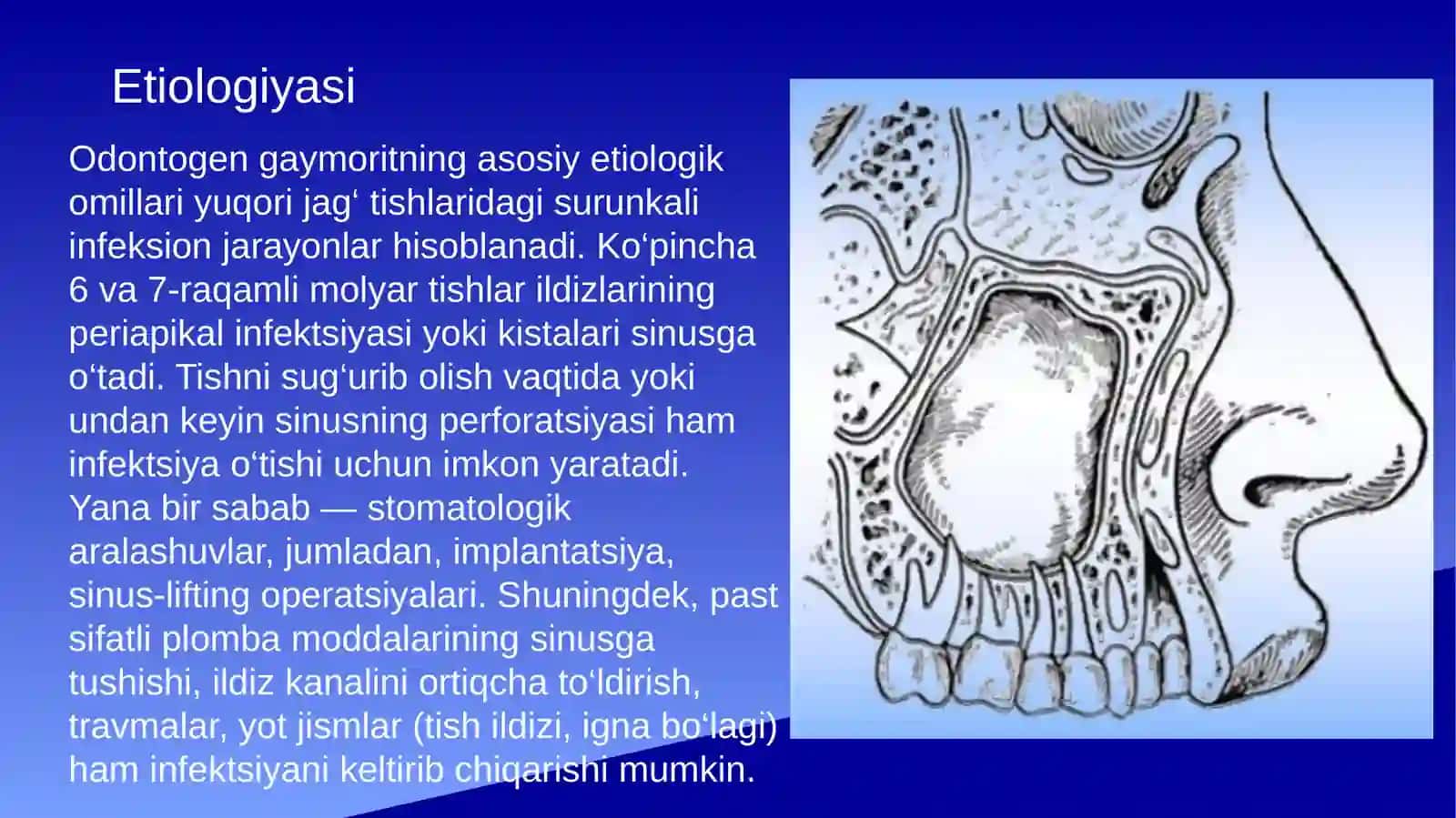 Odontogen gaymorit. Tashxislash va davolash usullari algoritmlari 4