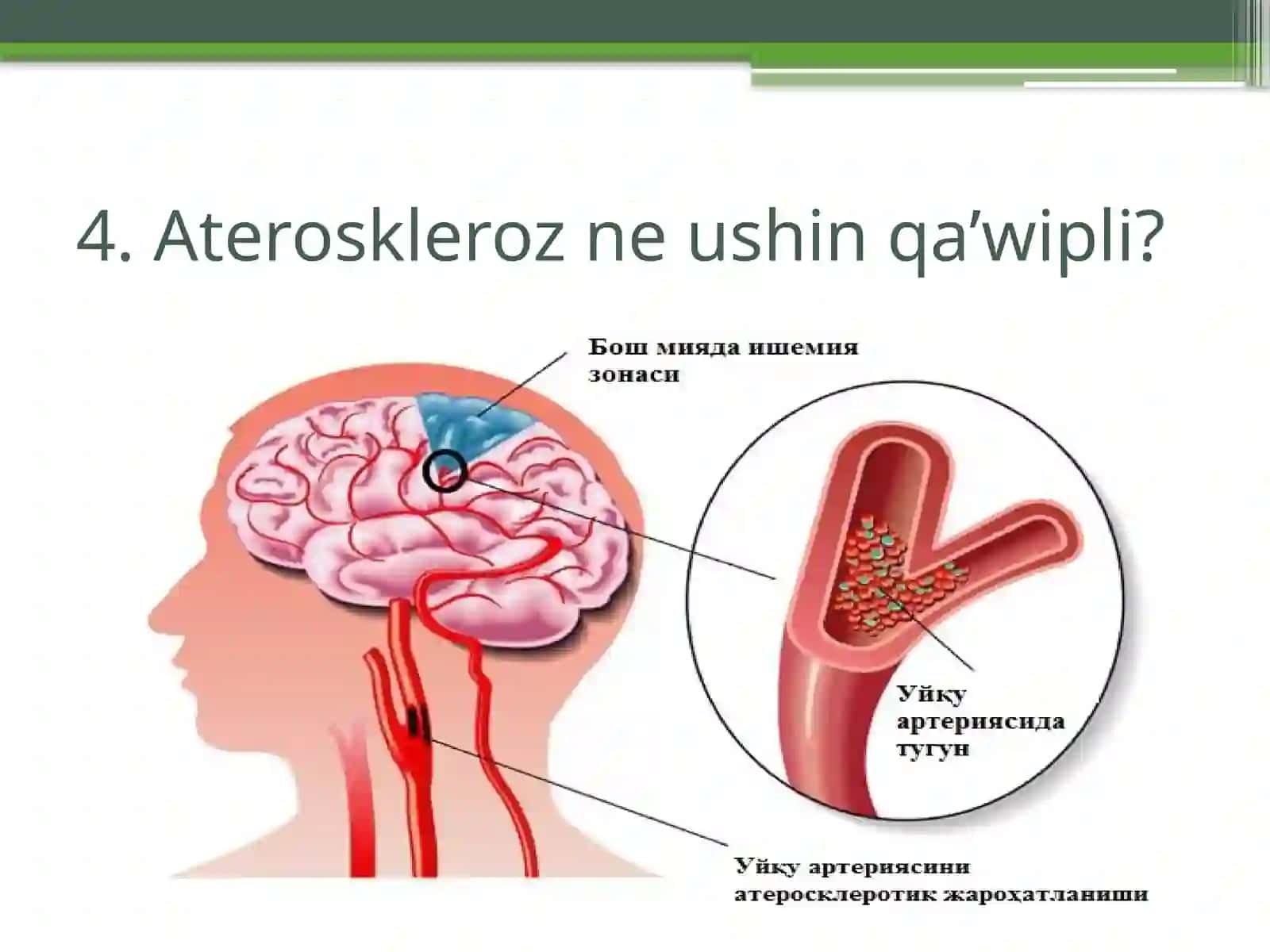 Ateroskleroz 4