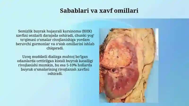 Buyrak oʻsmalari 4