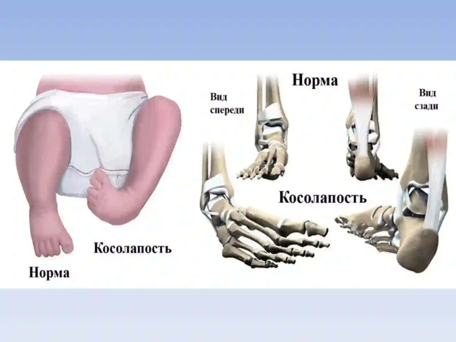 Врожденная косолапость (Congenital talipes equinovarus) 4
