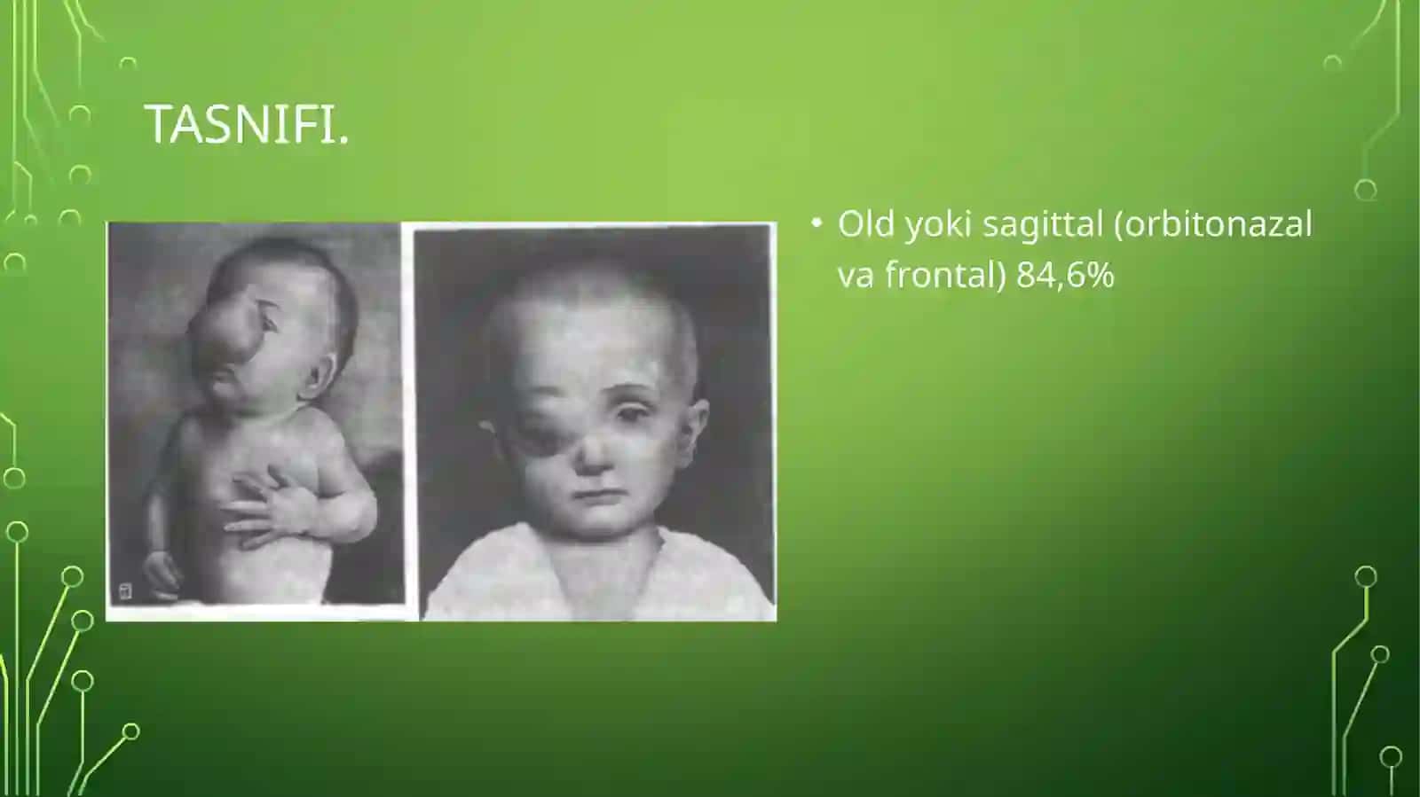 TUG'MA NUQSONLAR. BOLALARDA MIYA CHURRASI VA YURAK NUQSONLARI 4