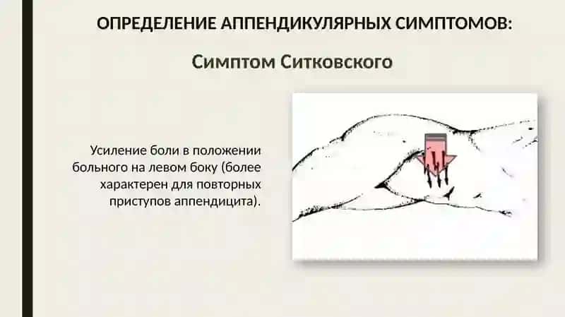 Ректальное исследование при тазовом аппендиците 4