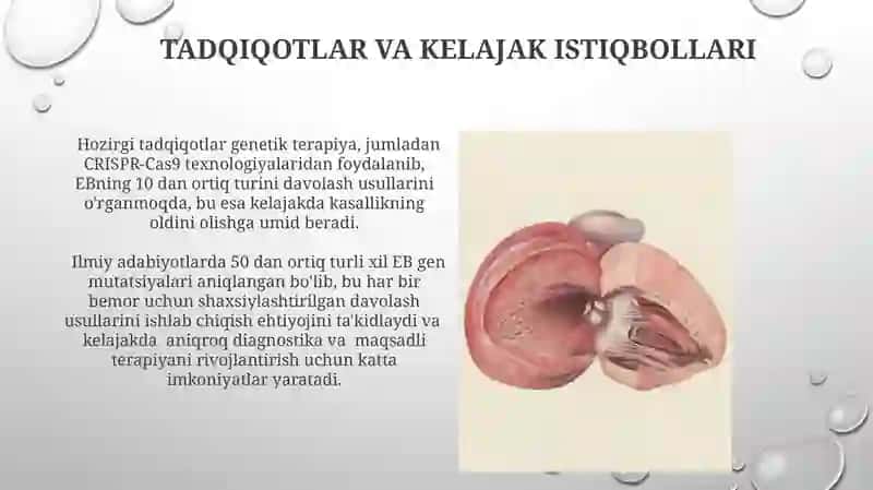 Bullyoz epidimoliz, xeyli- xeyli kasalligi 4