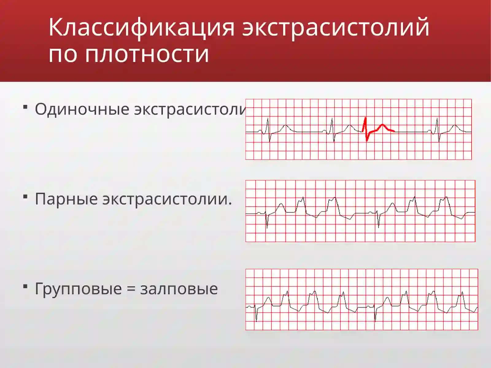 Экстрасистолии 4