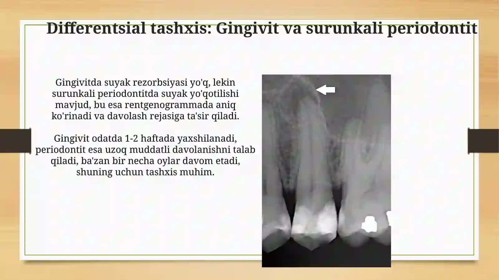 O‘tkir periodontitning klinik kechishi va diagnostikasi 4