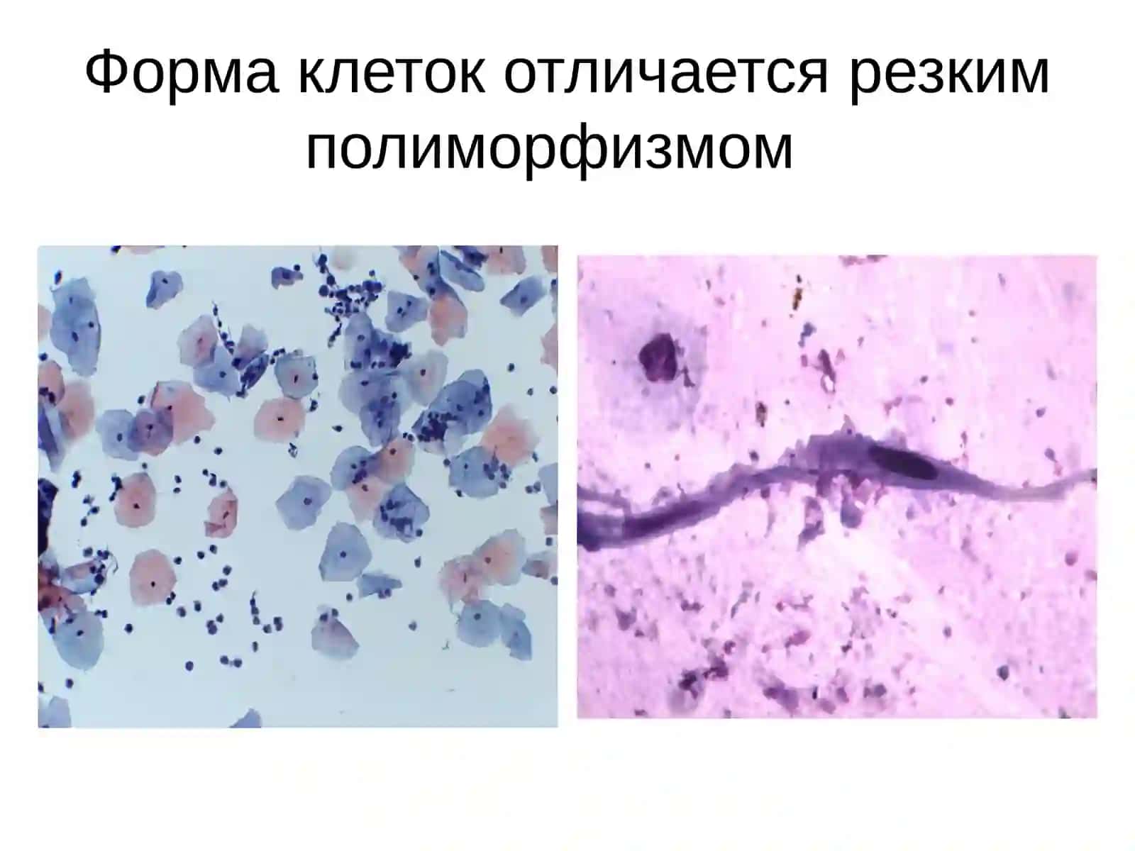 Определение злокачественности клеточных элементов 4