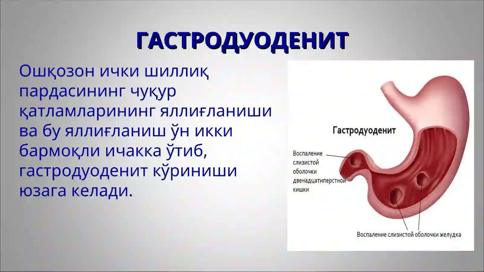 Гастрит ва гастродуоденитларнинг этиологияси, ташхисоти, клиник белгилари ва даволаш 4