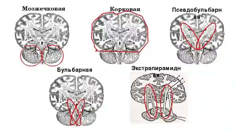 DIZARTRIYA 4
