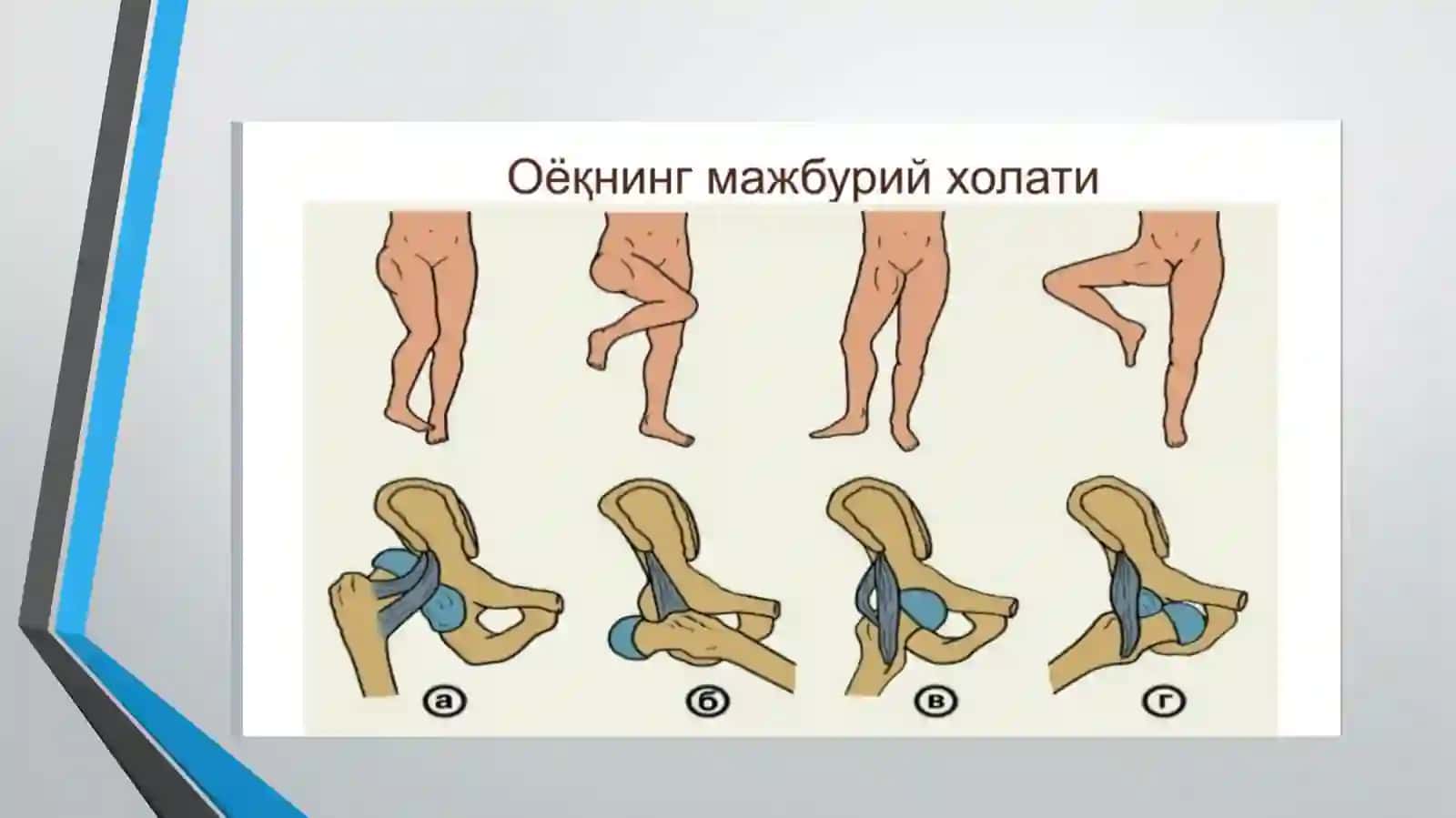 Son suyagi chiqishlari. Son suyagi boshchasining travmatik chiqishi 4