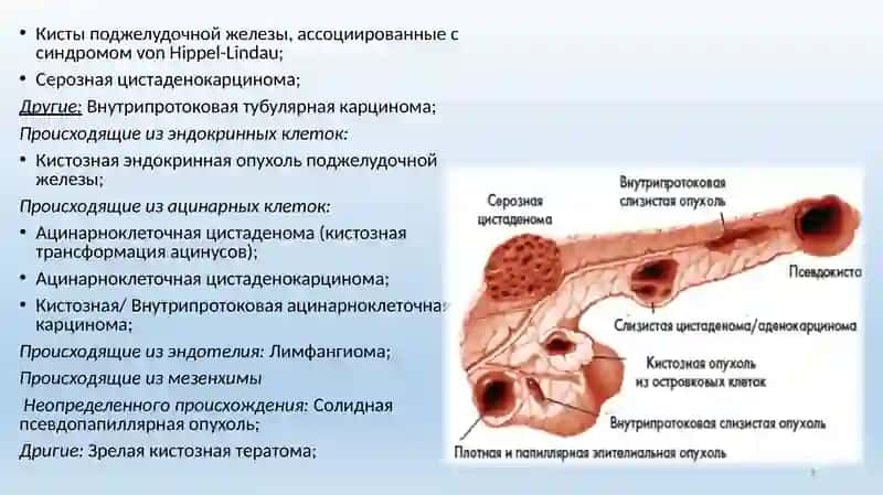 Кисты и кистозные опухоли поджелудочной железы 4