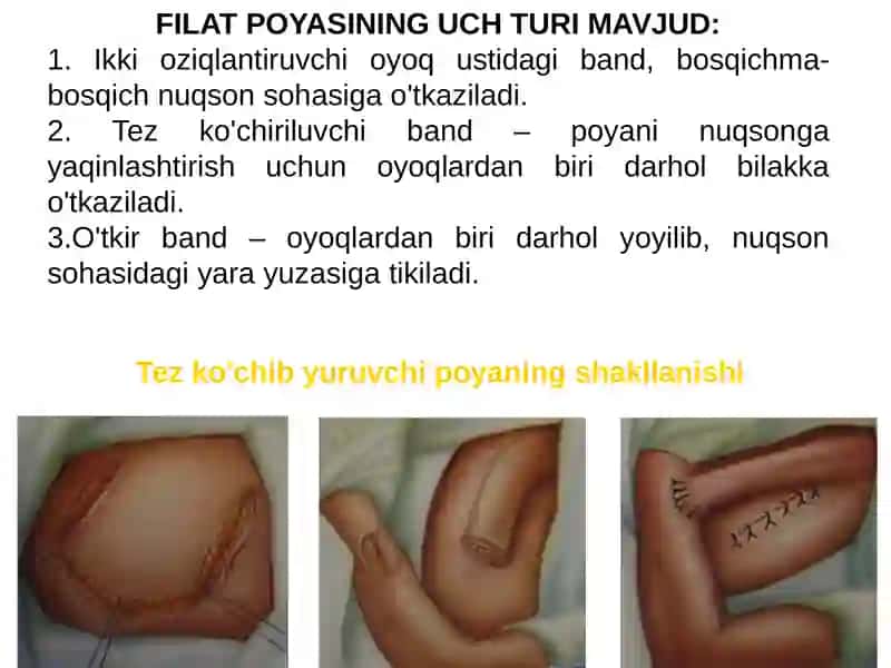 Filatov bandi bilan plastika 4