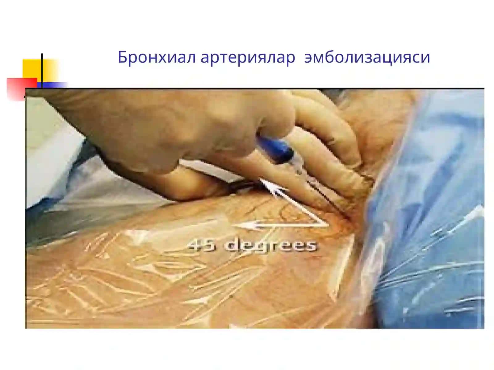 Сил касаллигида айрим холатларда беморни хаётига хавф тугдирадиган асоратлар 4