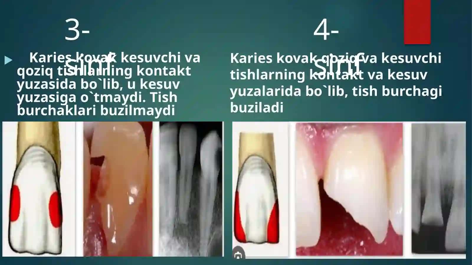 Fantomlarda V- VI sinf karioz bo‘shliqlarini charxlash va plombalash 4