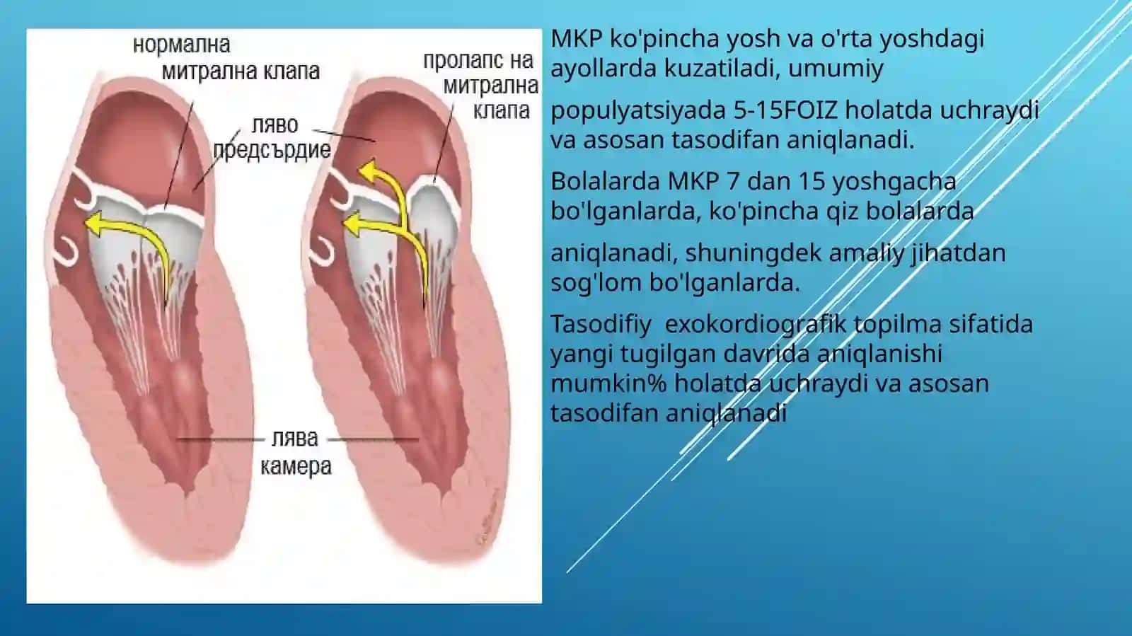 MITRAL KLAPAN PROLAPSI 4