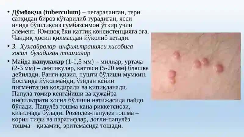 Ekzema bilan kechuvchi kasalliklar 4