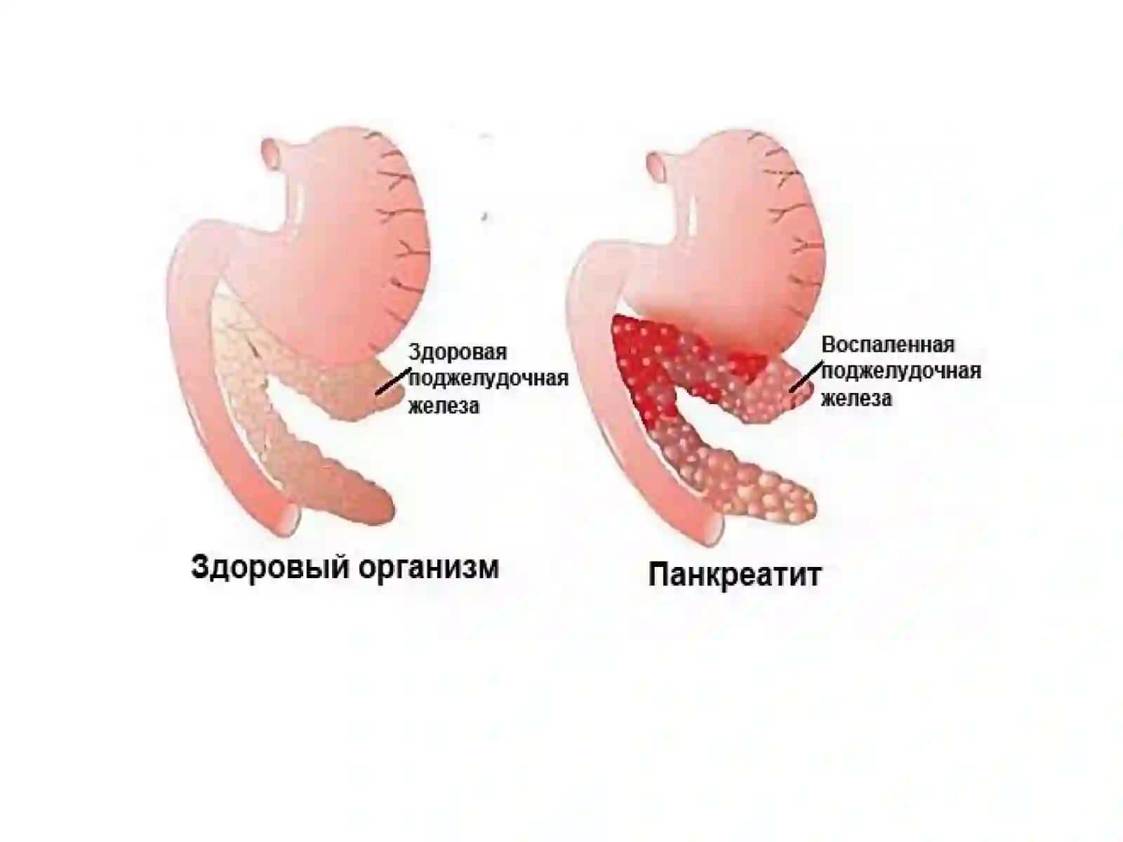 Oshqozonostibezikasalligi(Pankreatin) 4