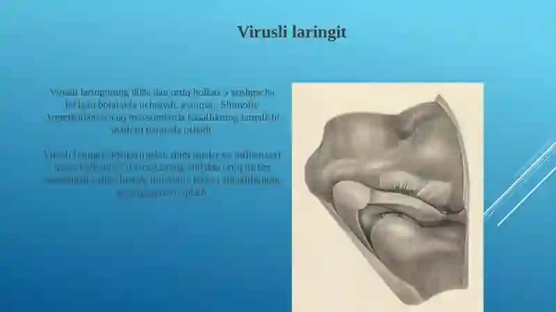 Laringit kassaligi kelib chiqishi sabablari va asoratlari 4