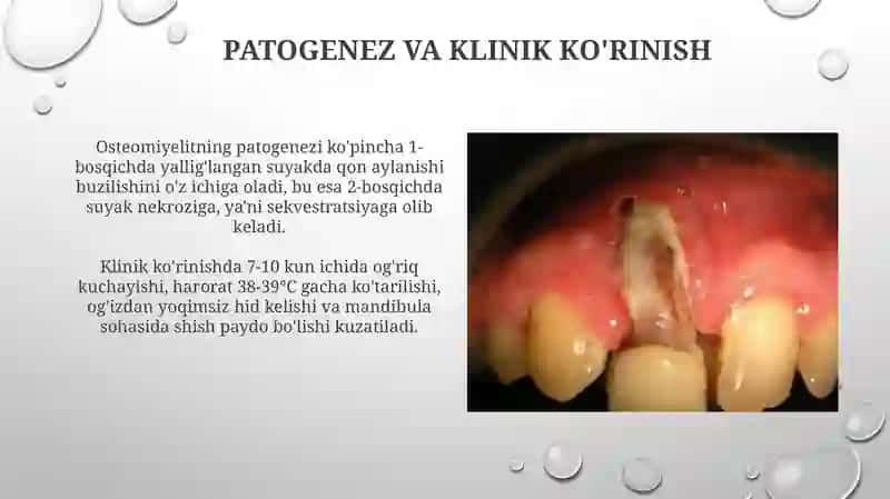 Yiqori jag' o'tkir osteomieliti va atrfidagi rivojlangan abssess va flegmonalari 4