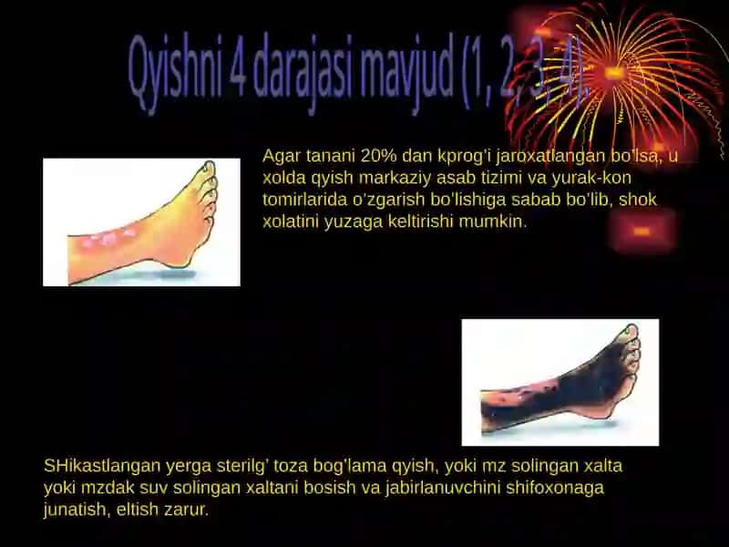 KUYISH DARAJALARI 4