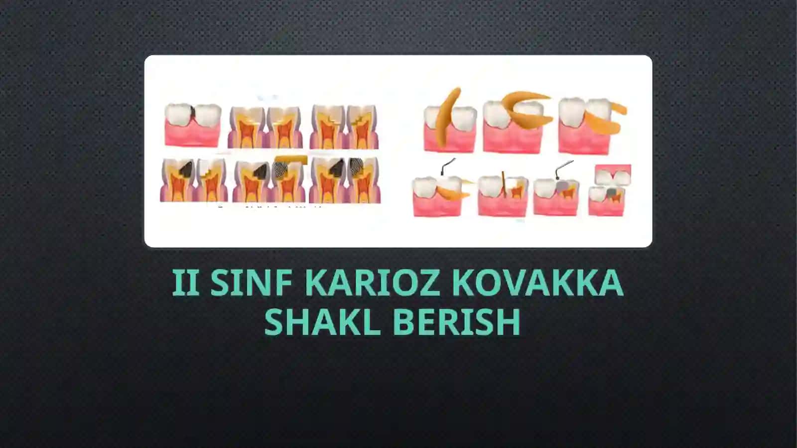 fantom xonalarda  vi sinf karioz bo'shliqlarga shakl berish va plombalash 4