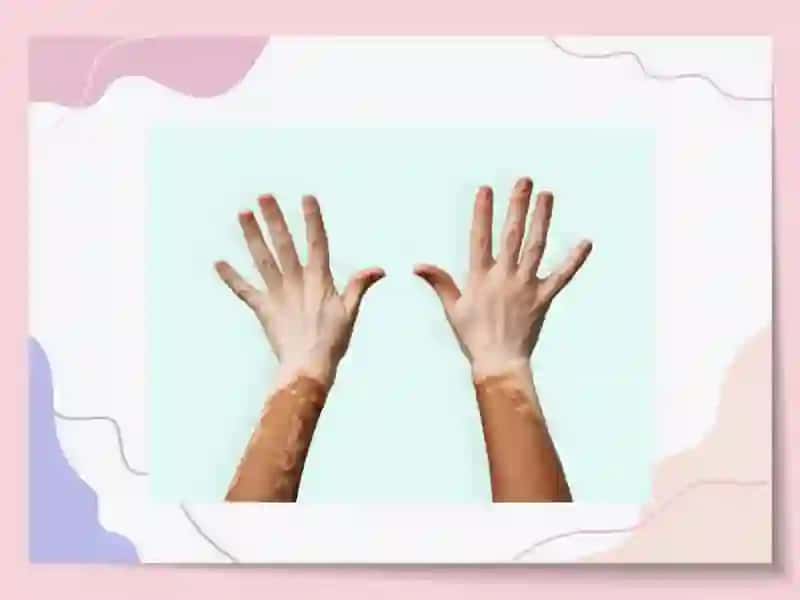 Vitiligo: Gistologiyasi, Etiologiyasi va Davolash 4
