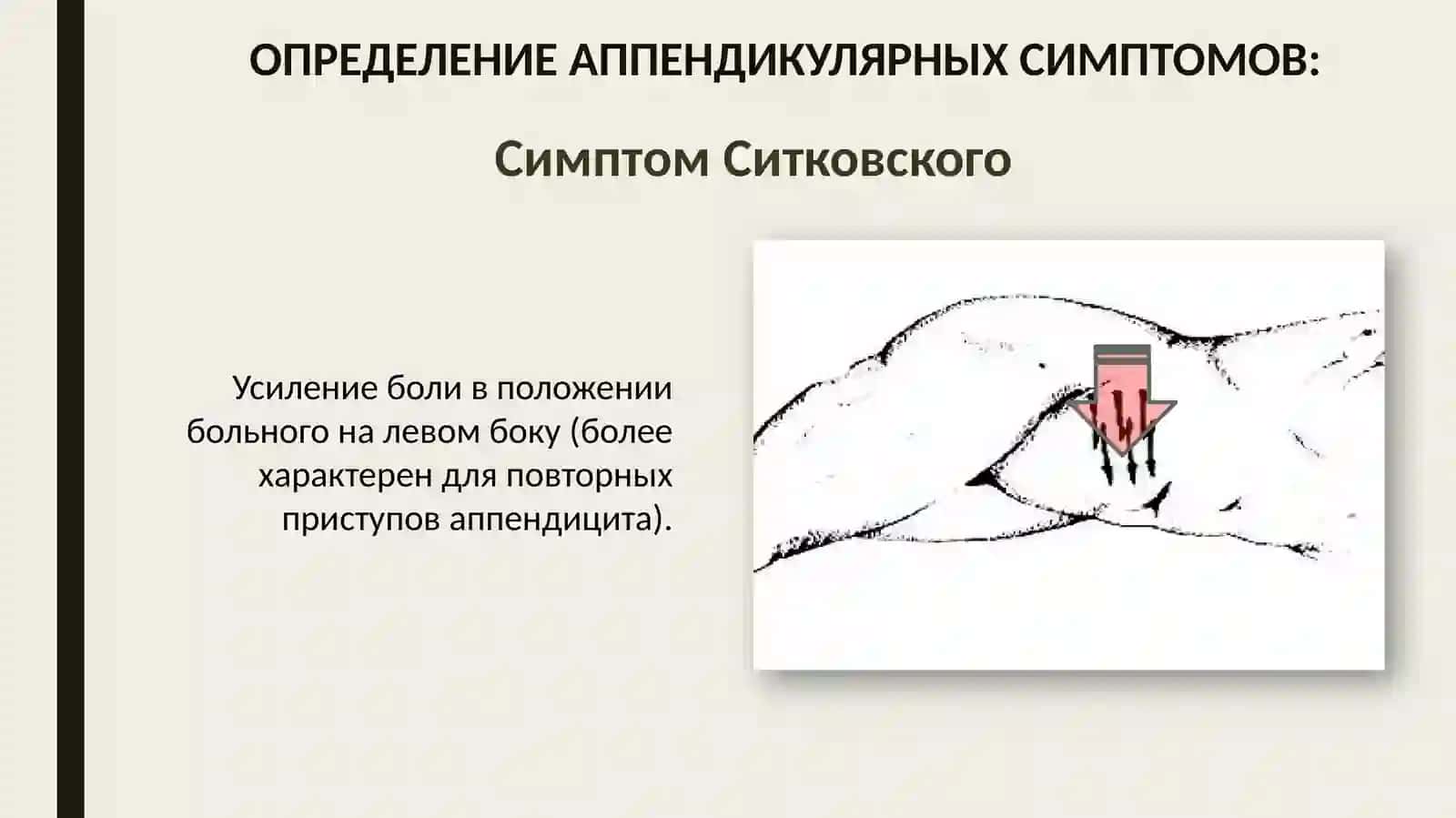 Ректальное исследование при тазовом аппендиците 4