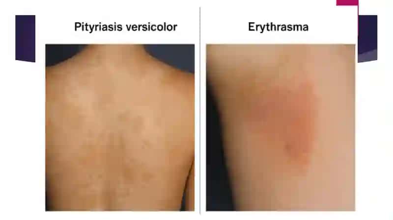 Keratomikozlar va Dermatomikozlar 4