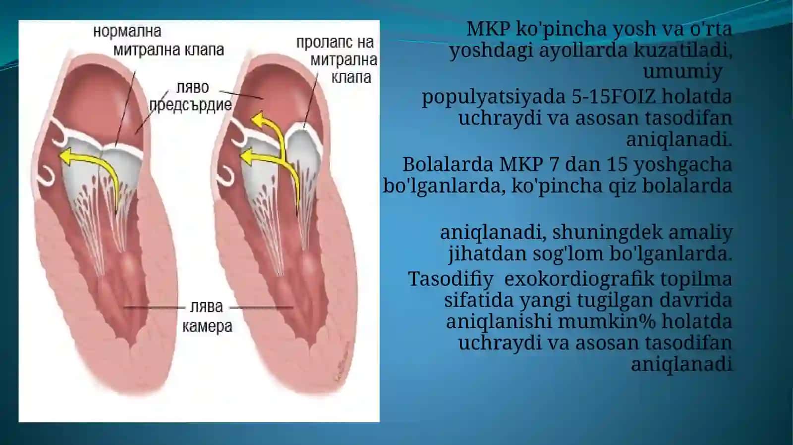 MITRAL KLAPAN PROLAPSI 4