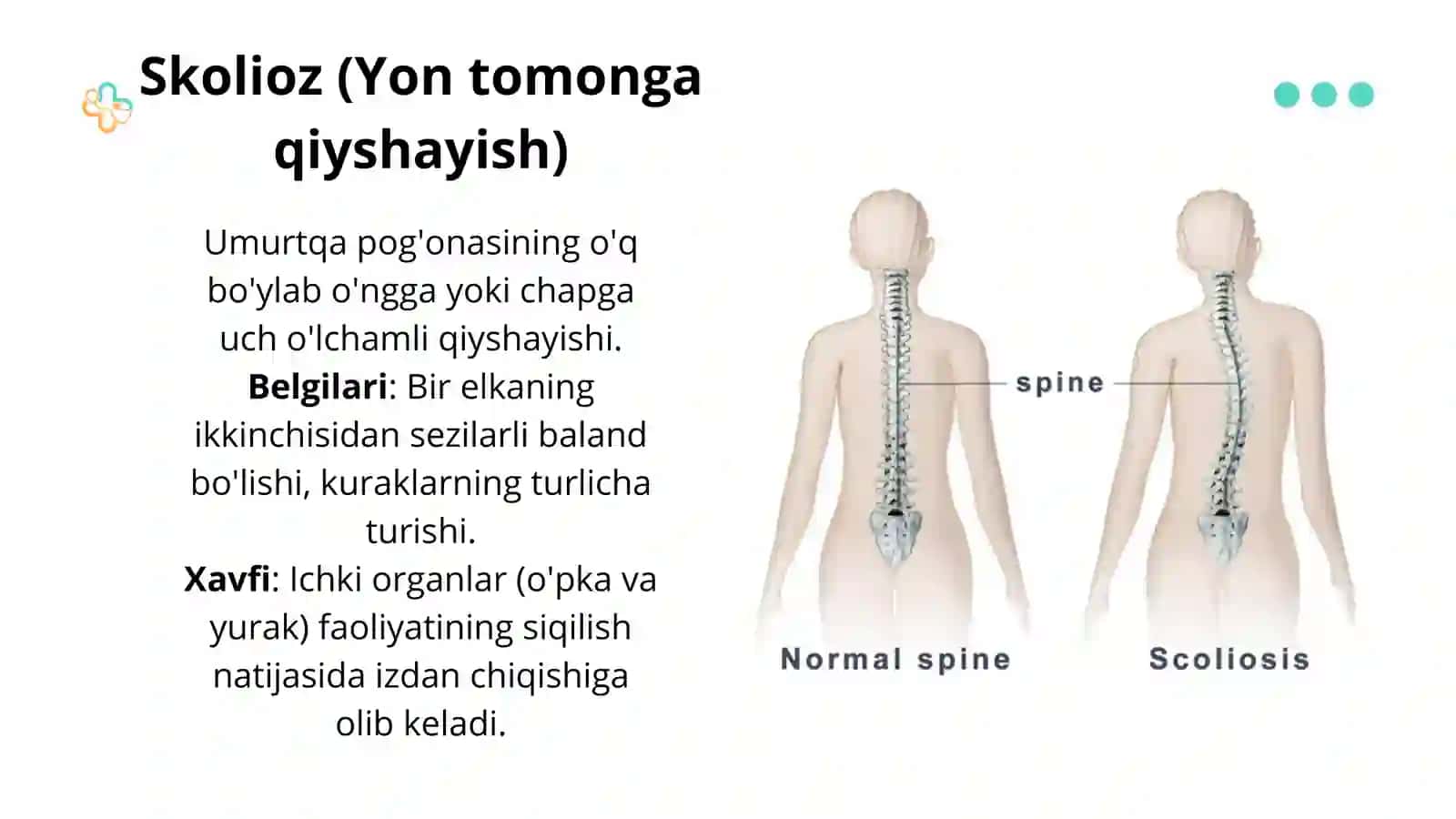 Bolalarda Qomat Buzilishi: Turlari, Sabablari va Oldini Olish — 15 Slaydli Taqdimot 4