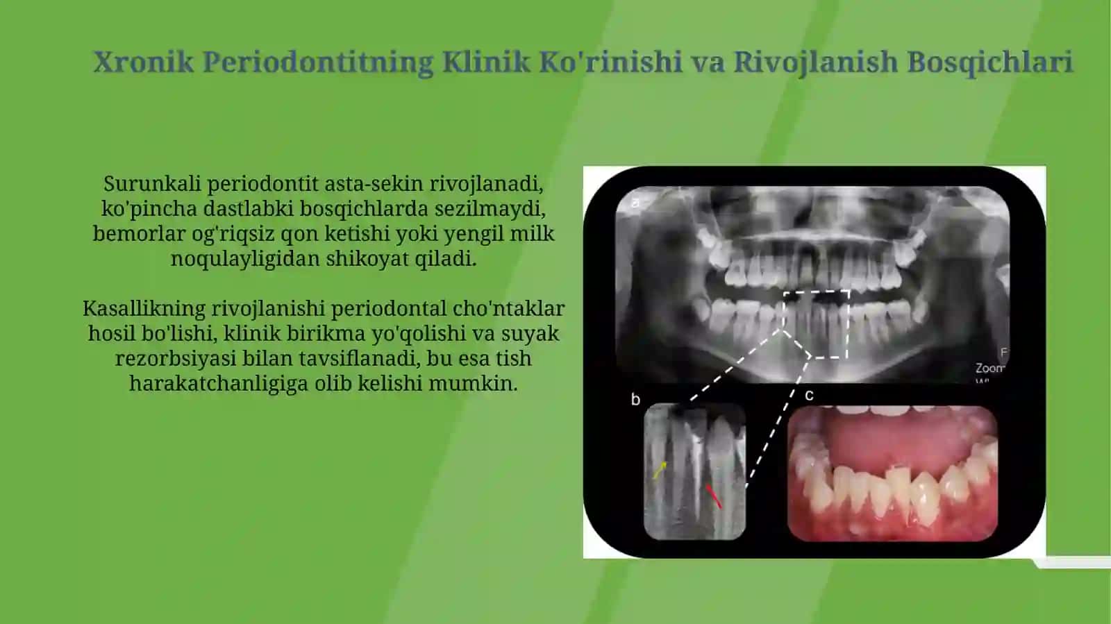 Surunkali periodontitlarning o‘ziga xos klinik kechishi, qiyosiy tashxisi. Rentgen tahlili 4