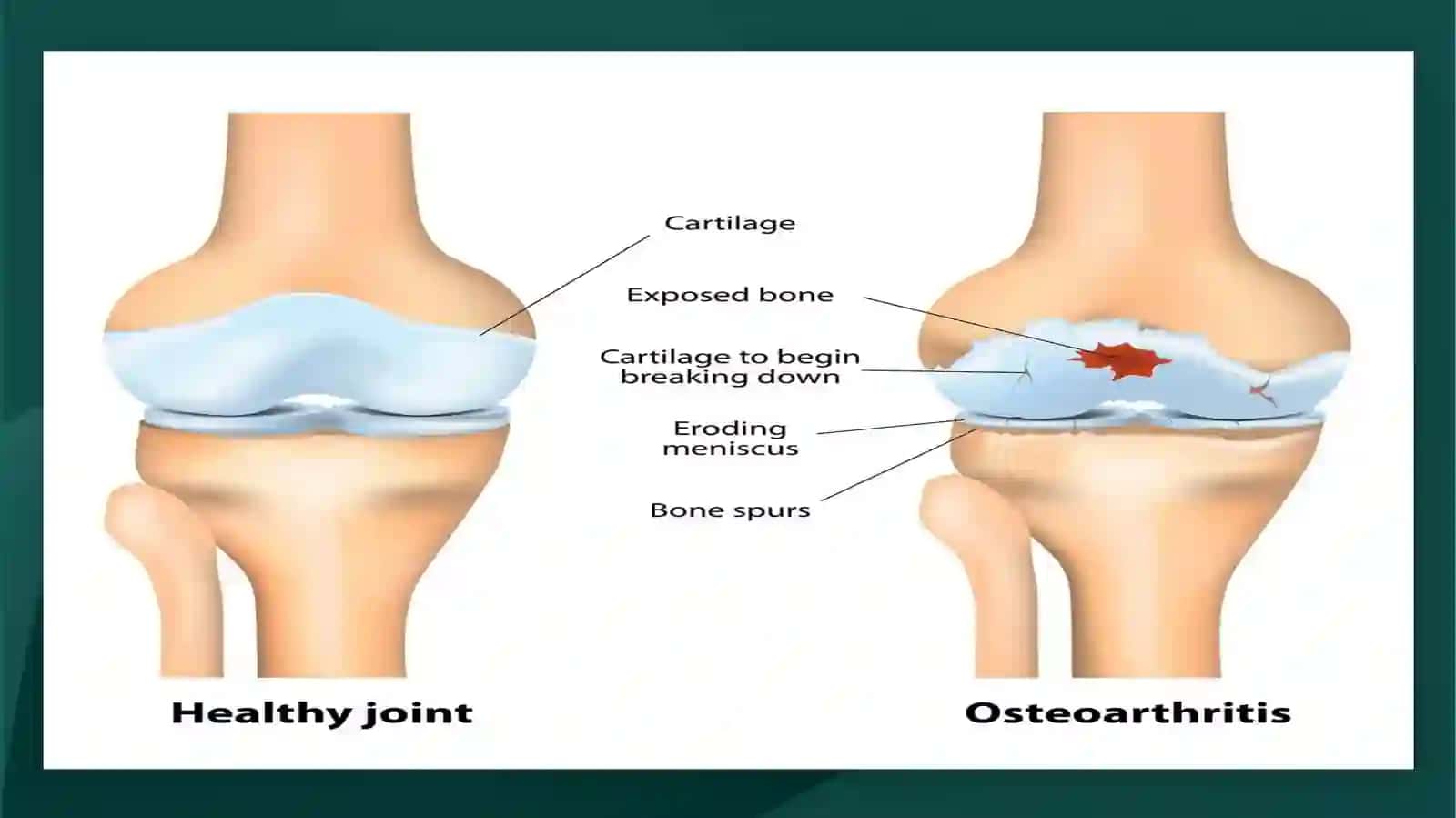 OSTEOARTROZ. DEFORMATSIYALOVCHI OSTEOARTROZ: ETIOLOGIYA, PATOGENEZ, KLINIKA, DIAGNOSTIKA, DAVOLASH 4