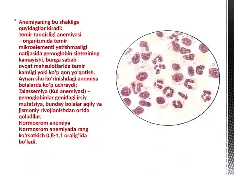 Aplastik Anemiya: Alomatlar. Aplastik Anemiya Diagnostikasi Va Davolash 4