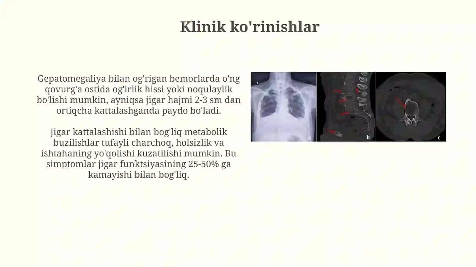 Gepatomegaliya klinik ko'rinishlari,kasallikning sindromal diagnostikasi 4