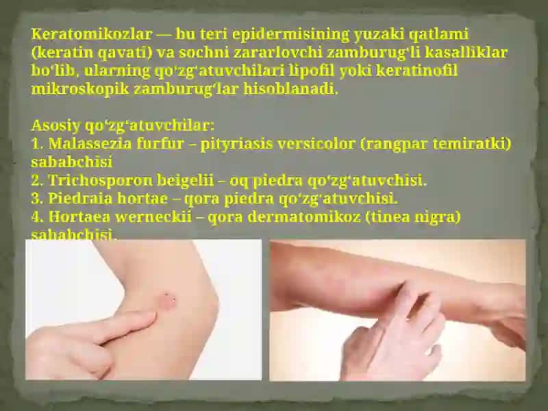 Terining zamburugʼli infektsiyalari. Keratomikozlar 4