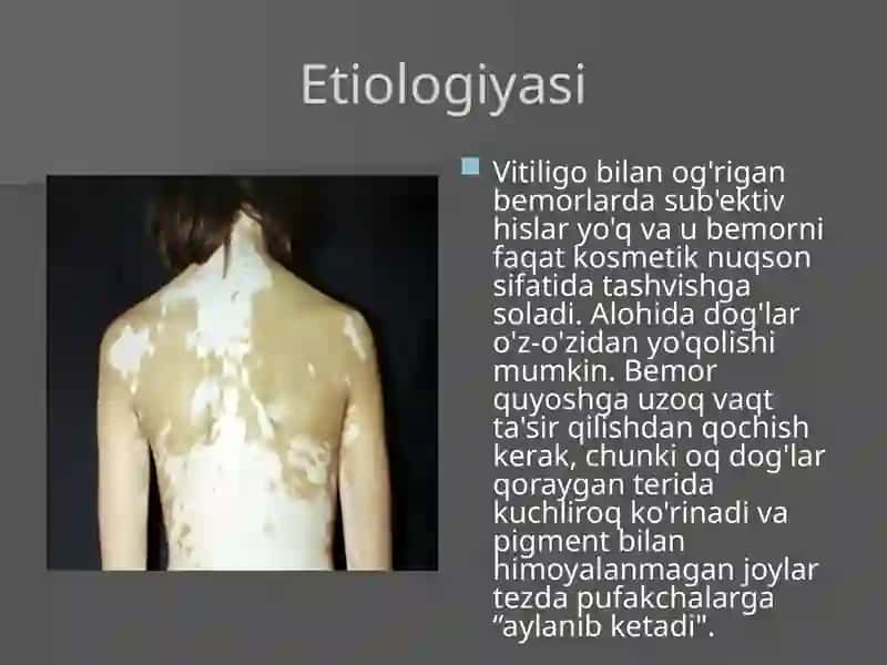 Vitiligo 4