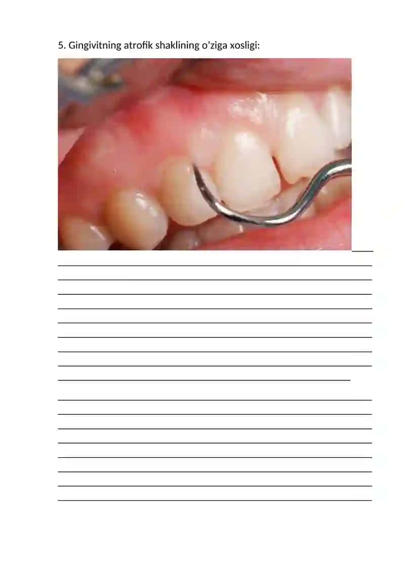 Bolalar o'tkir va surunkali, atrofik, kataral va gipertrofik gingivit. Bolalarda gingivitlarni davolash va profilaktika qilish 4