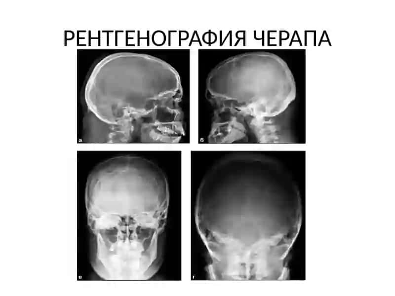 Лучевая диагностика заболеваний и повреждений черепа и головного мозга 4