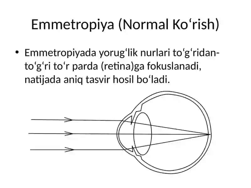 Miopiyalar.Emmetropiya, Miopiya va Gipermetropiya 4