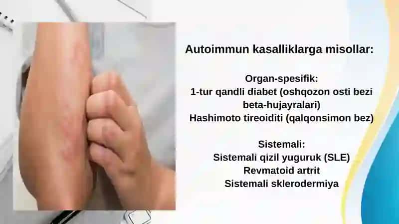 Immun tizim kasalliklari. HLA va uni kasalliklar bilan assotsiatsiyasi. Gipersezuvchanlik.Immuntolerantlik. Autoimmun kasalliklar mexanizmi. Immuntanqislik sindromi. Amiloidoz 4