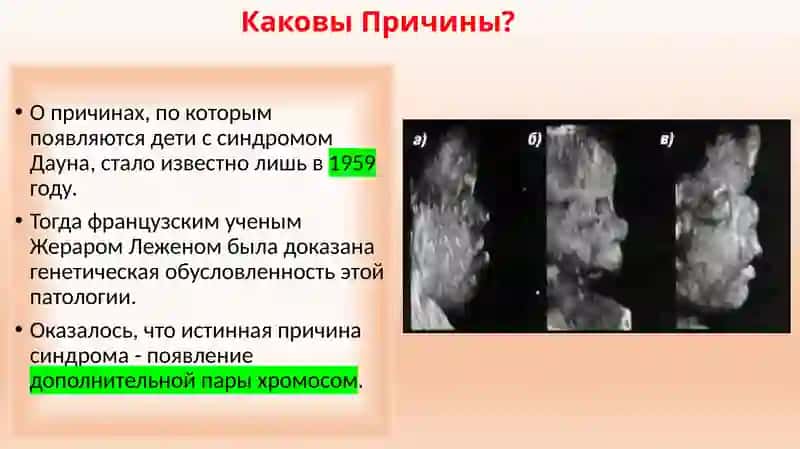 Синдром Дауна 4